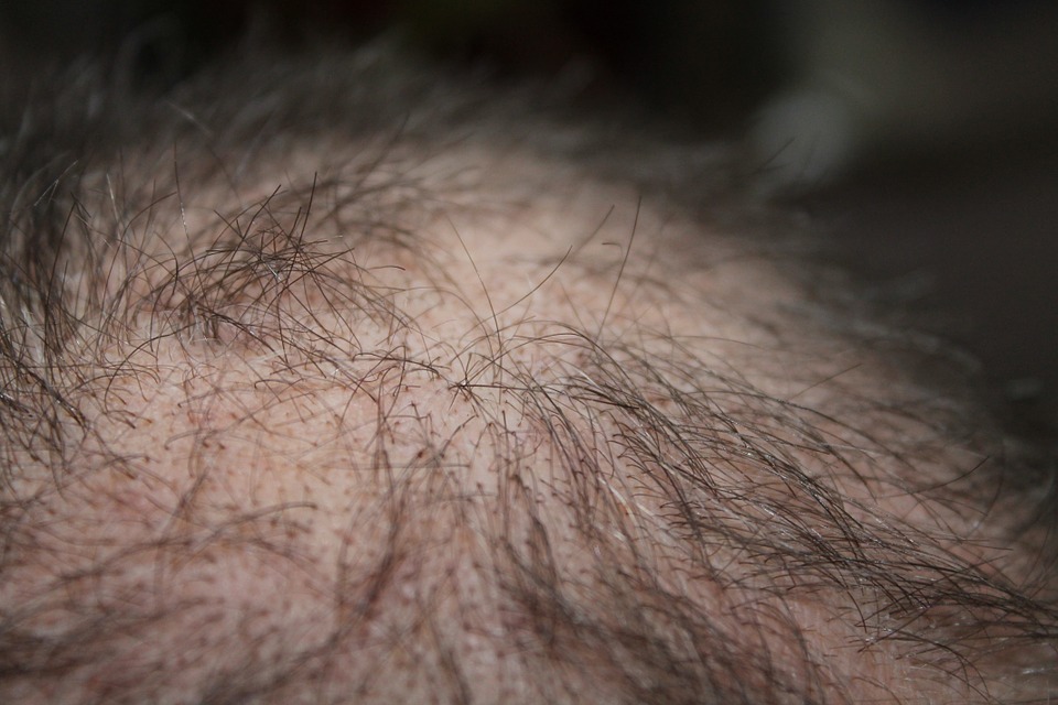 Image shows thinnig hair which happens in both men and women