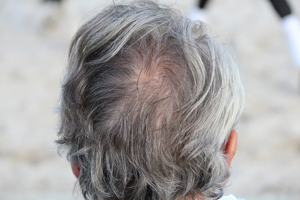 Man's back of head picture showing thinning hair and hair loss